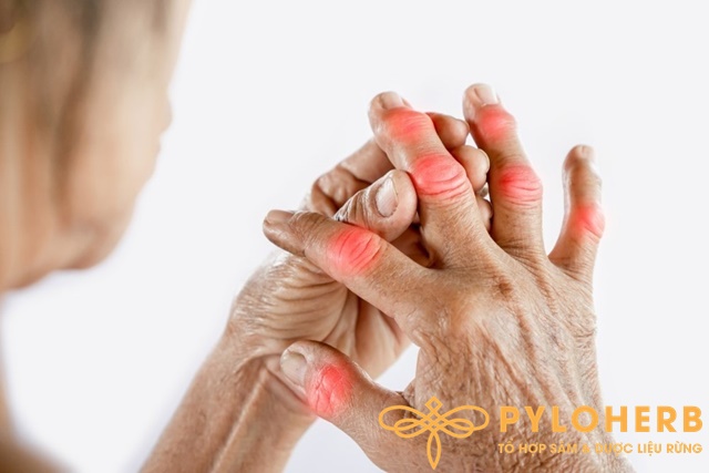Đừng Chủ Quan Với Những Dấu Hiệu Gout Nhẹ